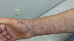 Michael's arm 2 post-cast 10-7-15